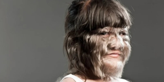 Nadir Hastalıklarda Teknolojik Devrim: ERDERA ile Çözümsüz Vakalar Aydınlanıyor