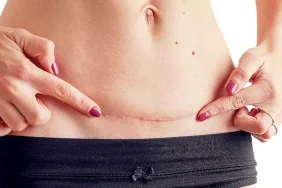 Normal Doğum ve Sezaryen Arasındaki Farklar