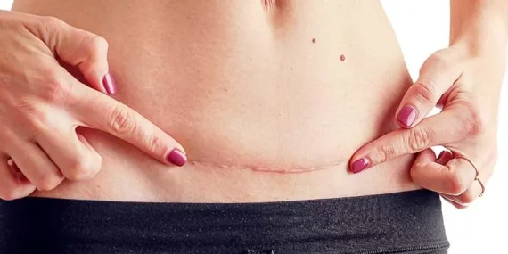 Normal Doğum ve Sezaryen Arasındaki Farklar